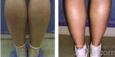 瘦腿針有效果嗎 肌肉型小腿的救星就是它