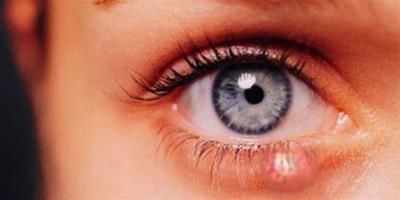 三層眼皮怎麼能變成二層眼皮 三眼皮產生的原因是什麼？